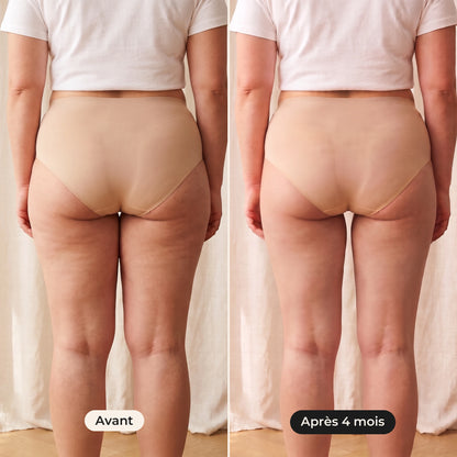 Legging de compression lipœdème